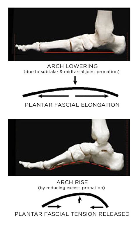 Plantar Fasciitis 的图像结果