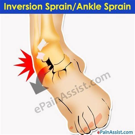 Pin on Sprained Ankle