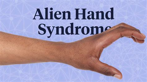 Image result for Alien Hand Syndrome Documentary