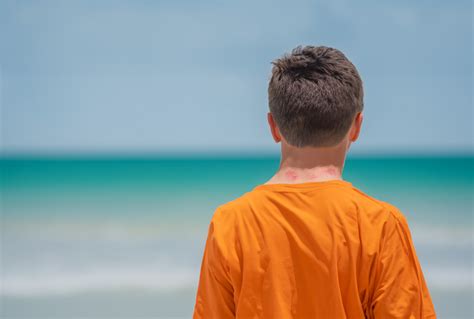 How to Treat and Prevent Back Acne | UHealth Collective