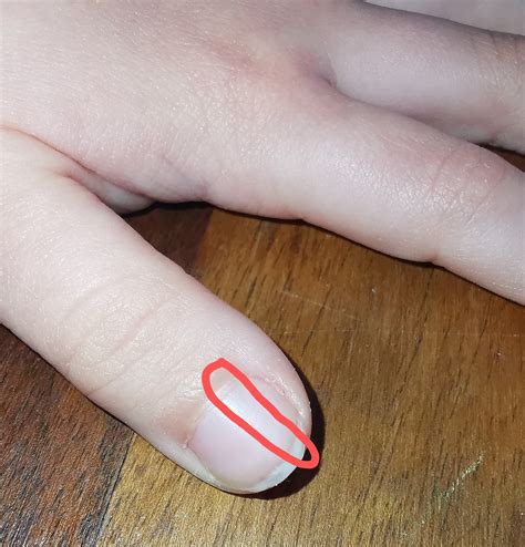 Black Lines In Fingernails Melanoma Black Line On Nails. Subungual