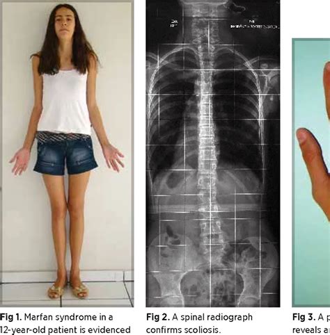 A complete guide to living a healthy life with Marfan syndrome