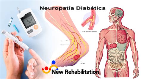 Que Es La Neuropatia