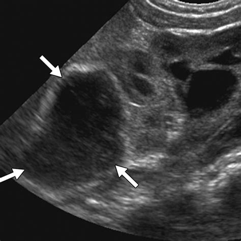 Focal Cystic Abdominal Masses in Pediatric Patients | AJR