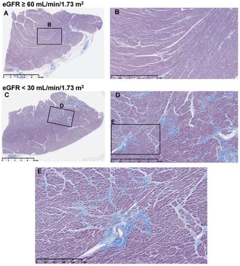 Non-Ischemic Myocardial Fibrosis in End-Stage Kidney Disease Patients ...