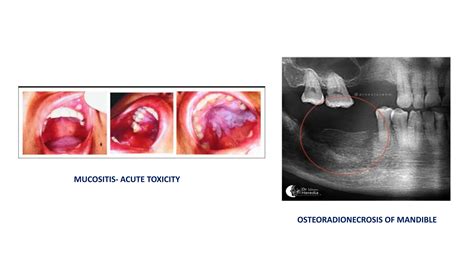 radiotherapy in head and neck cancers.pptx