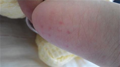 一周岁宝宝脚底板一开始是红点脚底板长米粒大小的水痘_第二人生