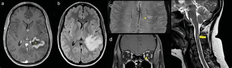 Hirntumor, oder doch etwas anderes? - Neurologie - Universimed ...