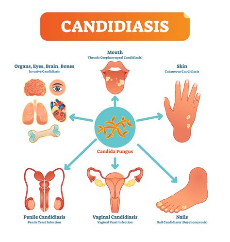 Candidiase Pode Ser Transmitido - FDPLEARN