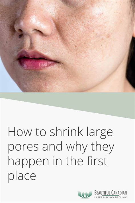 How to Shrink Large Pores & Why They Happen in the First Place