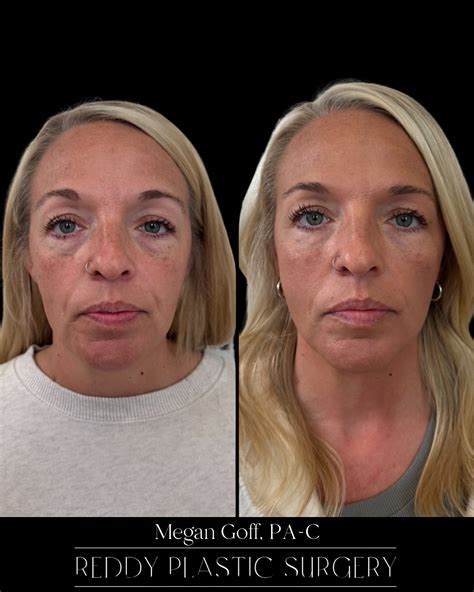 Reddy Plastic Surgery (@reddyplasticsurgery) • Instagram photos and videos