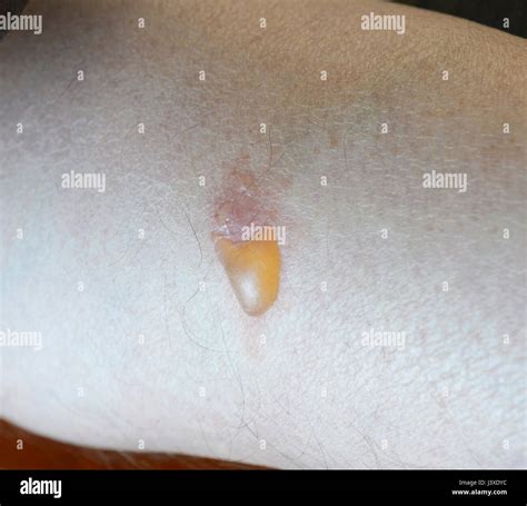 Leech Bite Stock Photos & Leech Bite Stock Images - Alamy