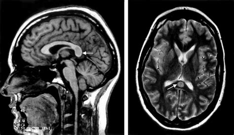 Transient lesion in the splenium of the corpus callosum: three further cases in epileptic ...