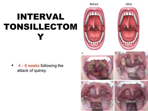 Quinsy or Peritonsillar Abscess.pptx