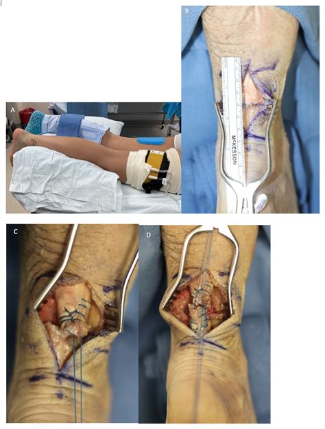A New Modified Giftbox Achilles Tendon Repair: A Surgical Technique ...