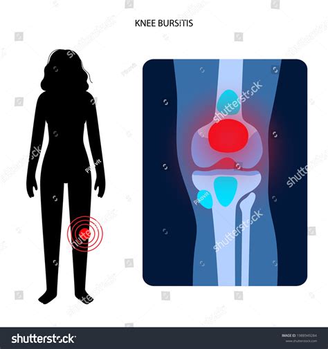 Knee Bursitis Not Healing at Marcia Lozada blog