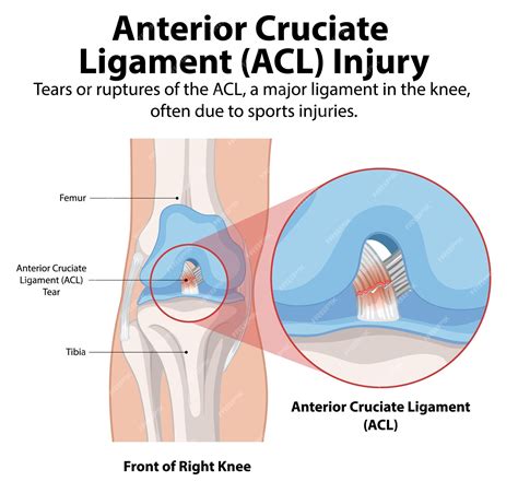 Lesión del LCA y anatomía de la rodilla | Vector Gratis