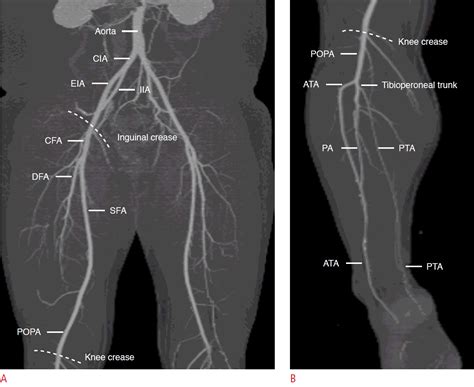 Peroneal Vessels : Surgical Exposure of the Lower Extremity Arteries – HQUE