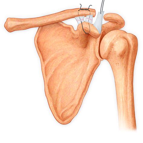 How To Help A Torn Ligament In Shoulder at Ali Winston blog