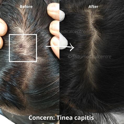 Tinea Capitis Treatment