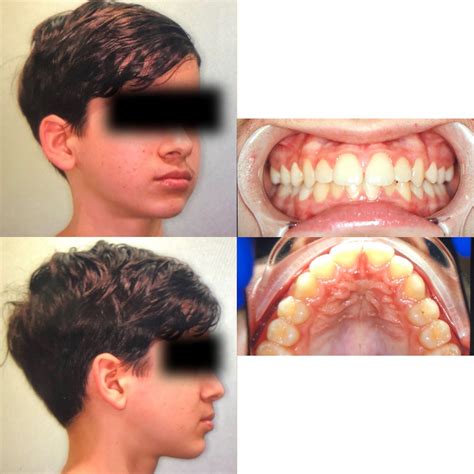 Eric Davis Dental - Buck Teeth: The Causes and Treatment for Buck Teeth