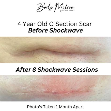 C-Section Scar Treatment - Body Motion Physical Therapy