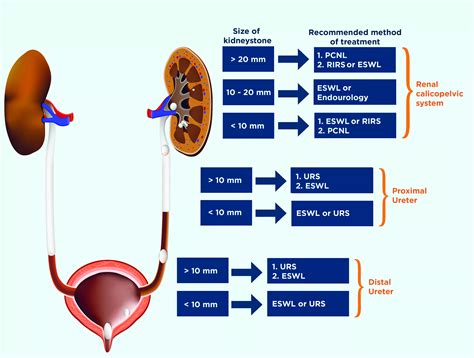 Kidney stones and treatment methods — Dornier MedTech Americas