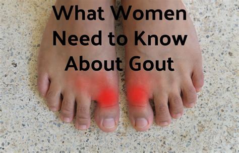 What Women Need to Know About Gout | Rocky Mountain Foot and Ankle ...