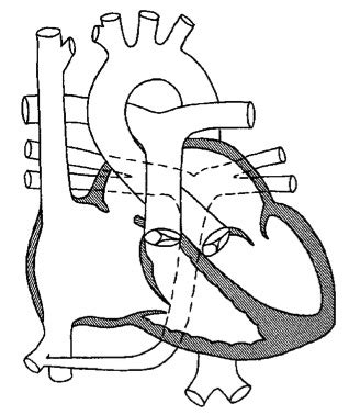 TAPVD (Total pulmoner venöz dönüş anomalisi)