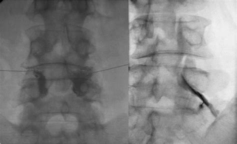 Fluoroscopy Injection 的图像结果