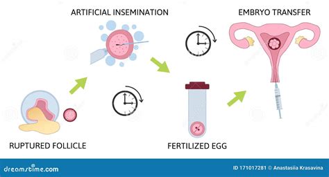 Image result for Vitro Fertilization IVF Process