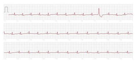 Image result for PVC ECG Reading