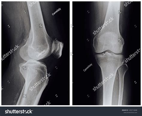 Xray Knee Osteoarthritis