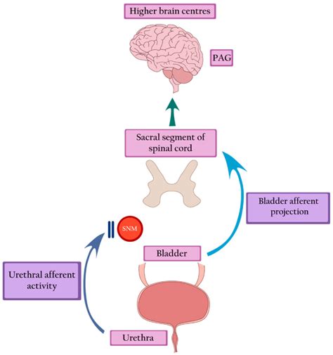Fowler’s Syndrome—The Cause of Urinary Retention in Young Women, Often ...