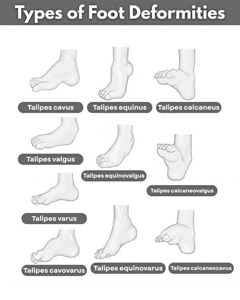 Types of Foot Deformities (Talipes) ️ Talipes cavus → High arch of the ...