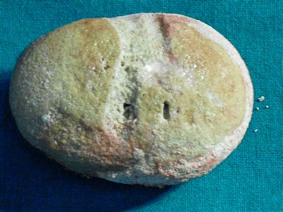 Bladder Stone | Anandan's Urology Clinic