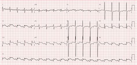 Abnormal Ecg Examples