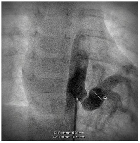 Transcatheter Management of Pulmonary Sequestrations in Children—A ...