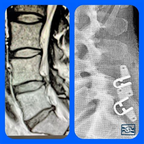 Técnica de la inserción de dispositivos interespinosos | Blogs Quirónsalud