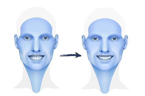 How To Fix Mouth Breather Face (Adenoid Face): Does Mouth Breathing ...