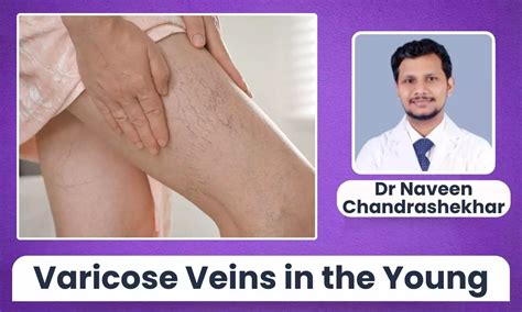 Varicose Veins in the Young: Are Sedentary Jobs to Blame? - Dr Naveen ...