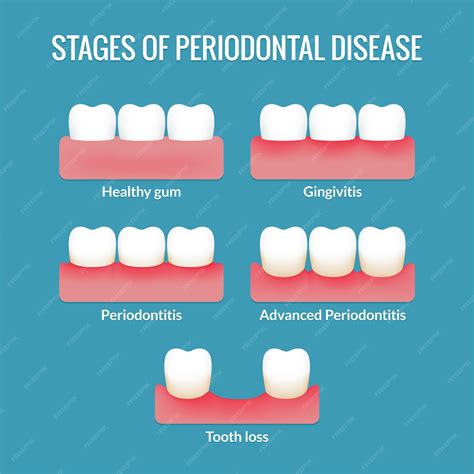 Premium Vector | Stages of periodontal disease from healthy gums to gingivitis, periodontitis ...