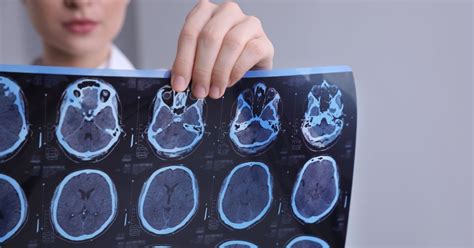 CTE Brain 的图像结果