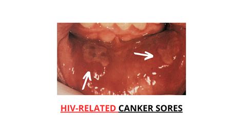 HIV Mouth Sores: A Complete Visual Guide with Pictures