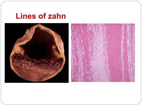 Thrombosis, embolism and infarction