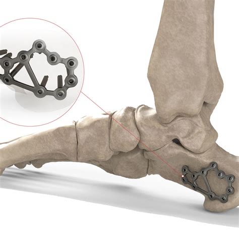 Compression Plate Ankle 的图像结果