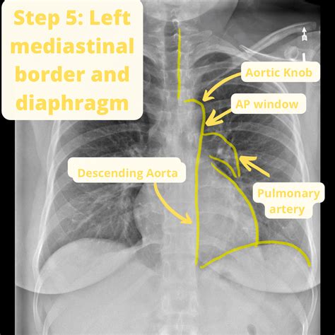 How to Read a Chest X-ray in 10 steps