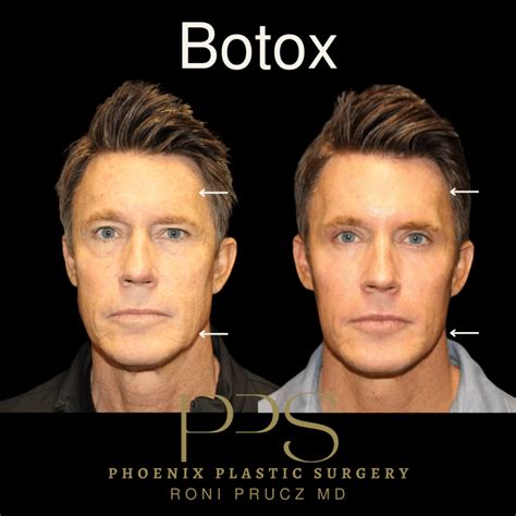 Botox Phoenix | Botox Scottsdale Arizona