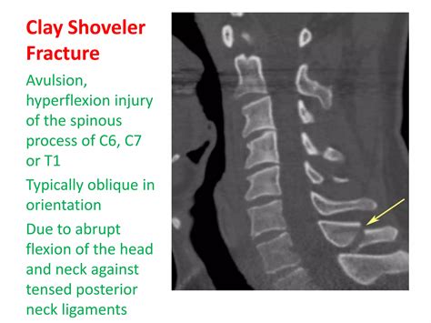 Name fractures | PPTX