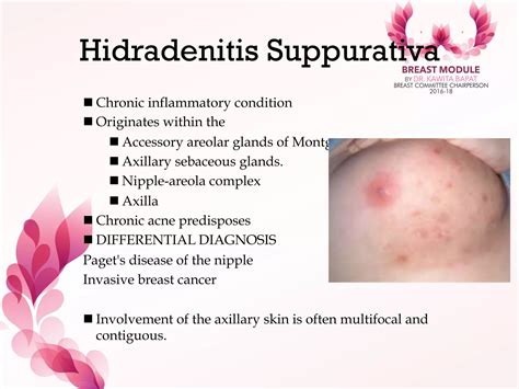 Infections of breast | PDF